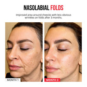 Parches de microagujas autodisolventes