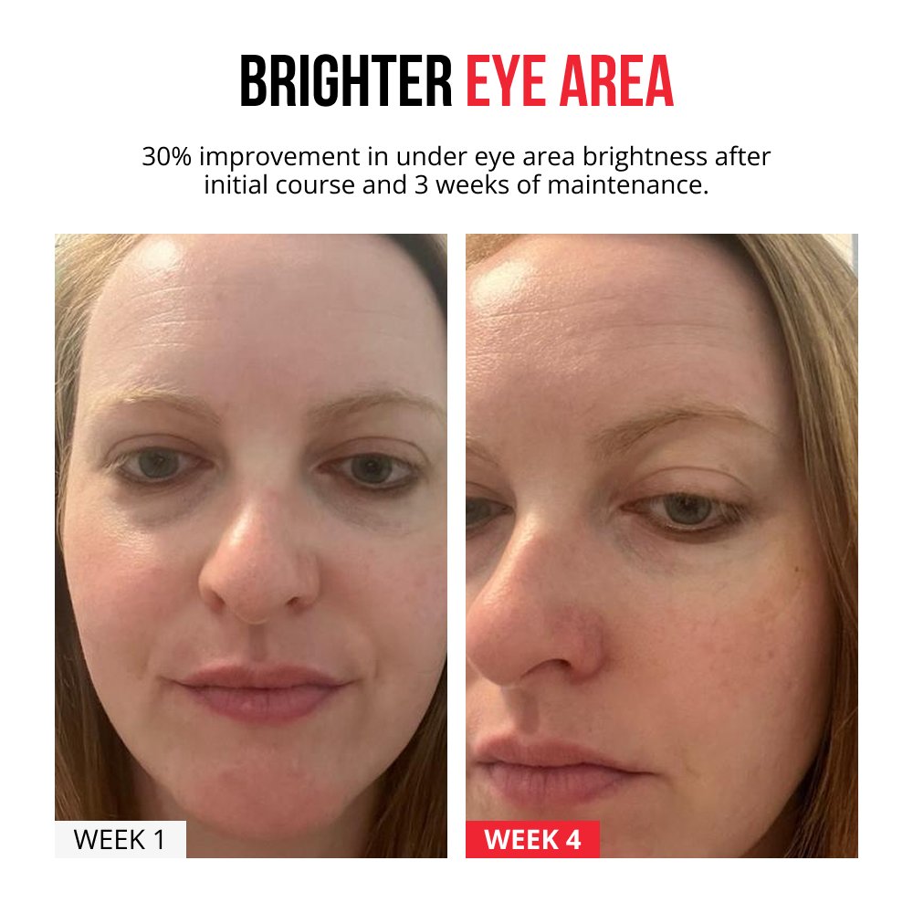 Parches de microagujas autodisolventes